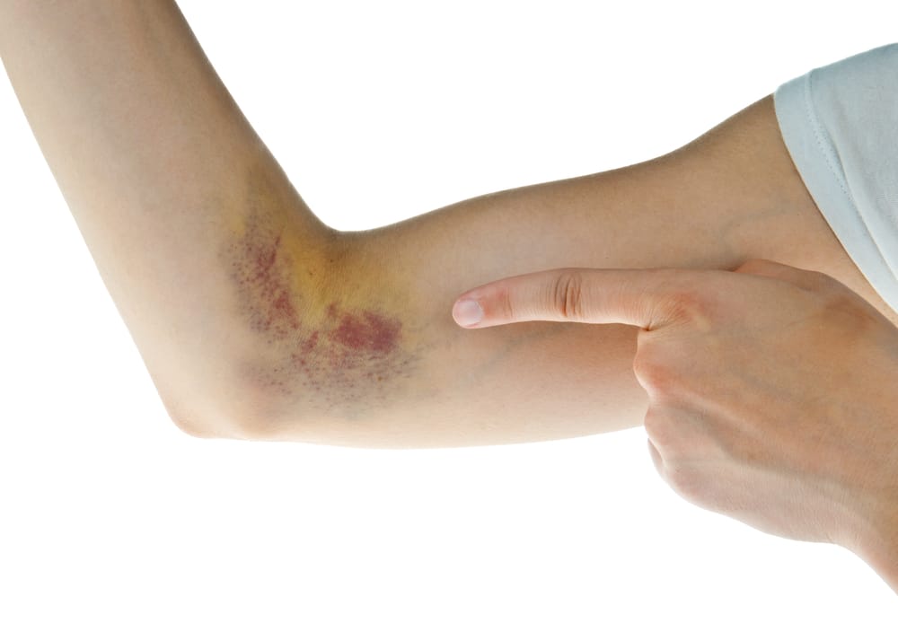 Bruising caused by a practitioner that learnt techniques at a IASTM certification